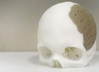 3D Printer Helps Replace 75 Percent Of Man’s Skull